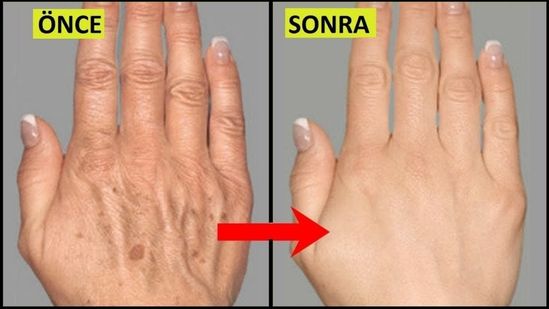 Ünlü Dermatoloji Uzmanın Tarifi İle Ciltteki Lekelerden Kurtulun